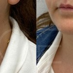 Source: Dr. Moubayed’s practice. Not a guarantee of results. Photos published with informed written consent of patients Female treated with deep neck lift and facelift in Montreal