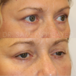 Source: Dr. Moubayed’s practice. Not a guarantee of results. Photos published with informed written consent of patients Female treated with lower blepharoplasty in Montreal
