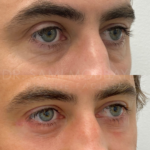 Source: Dr. Moubayed’s practice. Not a guarantee of results. Photos published with informed written consent of patients Female treated with lower blepharoplasty in Montreal