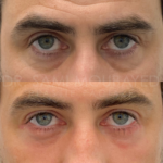 Source: Dr. Moubayed’s practice. Not a guarantee of results. Photos published with informed written consent of patients Female treated with lower blepharoplasty in Montreal