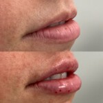 Source: Dr. Moubayed’s practice. Not a guarantee of results. Photos published with informed written consent of patients Female treated with lip fillers
