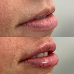 Source : Cabinet du Dr Moubayed. Ne constitue pas une garantie de résultats. Photos publiées avec le consentement écrit et éclairé des patients Femme traitée avec des lip fillers