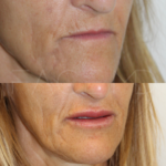 Source: Dr. Moubayed’s practice. Not a guarantee of results. Photos published with informed written consent of patients