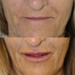 Source : Cabinet du Dr Moubayed. Ne constitue pas une garantie de résultats. Photos publiées avec le consentement écrit et éclairé des patients Femme traitée avec des lip fillers