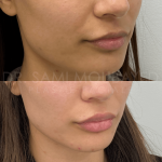 Source : Cabinet du Dr Moubayed. Ne constitue pas une garantie de résultats. Photos publiées avec le consentement écrit et éclairé des patients Femme traitée avec des lip fillers