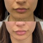 Source : Cabinet du Dr Moubayed. Ne constitue pas une garantie de résultats. Photos publiées avec le consentement écrit et éclairé des patients Femme traitée avec des lip fillers