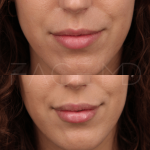 Source : Cabinet du Dr Moubayed. Ne constitue pas une garantie de résultats. Photos publiées avec le consentement écrit et éclairé des patients Femme traitée avec des lip fillers