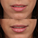 Source : Cabinet du Dr Moubayed. Ne constitue pas une garantie de résultats. Photos publiées avec le consentement écrit et éclairé des patients Femme traitée avec des lip fillers à Montréal