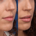 Source : Cabinet du Dr Moubayed. Ne constitue pas une garantie de résultats. Photos publiées avec le consentement écrit et éclairé des patients Femme traitée avec des lip fillers à Montréal