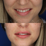 Source : Cabinet du Dr Moubayed. Ne constitue pas une garantie de résultats. Photos publiées avec le consentement écrit et éclairé des patients Femme traitée avec des lip fillers à Montréal