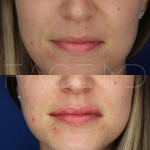 Source : Cabinet du Dr Moubayed. Ne constitue pas une garantie de résultats. Photos publiées avec le consentement écrit et éclairé des patients Femme traitée avec des lip fillers à Montréal