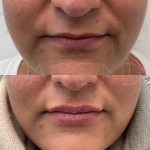 Source : Cabinet du Dr Moubayed. Ne constitue pas une garantie de résultats. Photos publiées avec le consentement écrit et éclairé des patients Femme traitée avec des lip fillers à Montréal