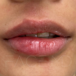 Source: Dr. Moubayed’s practice. Not a guarantee of results. Photos published with informed written consent of patients Lip fillers in progress (right side is treated)