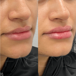 Source : Cabinet du Dr Moubayed. Ne constitue pas une garantie de résultats. Photos publiées avec le consentement écrit et éclairé des patients Femme traitée avec des lip fillers à Montréal