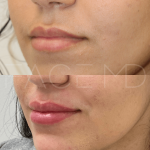 Source : Cabinet du Dr Moubayed. Ne constitue pas une garantie de résultats. Photos publiées avec le consentement écrit et éclairé des patients Femme traitée avec des lip fillers à Montréal