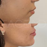 Source : Cabinet du Dr Moubayed. Ne constitue pas une garantie de résultats. Photos publiées avec le consentement écrit et éclairé des patients Femme traitée avec des lip fillers à Montréal