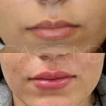 Source : Cabinet du Dr Moubayed. Ne constitue pas une garantie de résultats. Photos publiées avec le consentement écrit et éclairé des patients Femme traitée avec des lip fillers à Montréal