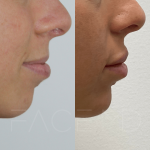 Source : Cabinet du Dr Moubayed. Ne constitue pas une garantie de résultats. Photos publiées avec le consentement écrit et éclairé des patients Femme traitée avec des lip fillers à Montréal