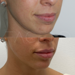 Source : Cabinet du Dr Moubayed. Ne constitue pas une garantie de résultats. Photos publiées avec le consentement écrit et éclairé des patients Femme traitée avec des lip fillers à Montréal