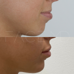 Source : Cabinet du Dr Moubayed. Ne constitue pas une garantie de résultats. Photos publiées avec le consentement écrit et éclairé des patients Femme traitée avec des lip fillers à Montréal