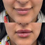 Source : Cabinet du Dr Moubayed. Ne constitue pas une garantie de résultats. Photos publiées avec le consentement écrit et éclairé des patients Femme traitée avec des lip fillers à Montréal