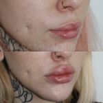 Source: Dr. Moubayed’s practice. Not a guarantee of results. Photos published with informed written consent of patients Female treated with upper lip lift
