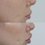 Source: Dr. Moubayed’s practice. Not a guarantee of results. Photos published with informed written consent of patients Female treated with upper lip lift