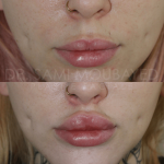 Source: Dr. Moubayed’s practice. Not a guarantee of results. Photos published with informed written consent of patients