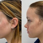 Source: Dr. Moubayed’s practice. Not a guarantee of results. Photos published with informed written consent of patients Female treated with upper lip lift