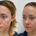 Source: Dr. Moubayed’s practice. Not a guarantee of results. Photos published with informed written consent of patients Female treated with upper lip lift