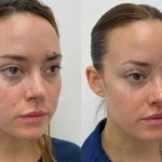 Source: Dr. Moubayed’s practice. Not a guarantee of results. Photos published with informed written consent of patients Female treated with upper lip lift