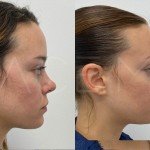 Source: Dr. Moubayed’s practice. Not a guarantee of results. Photos published with informed written consent of patients Female treated with upper lip lift