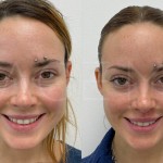 Source: Dr. Moubayed’s practice. Not a guarantee of results. Photos published with informed written consent of patients Female treated with upper lip lift