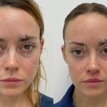 Source: Dr. Moubayed’s practice. Not a guarantee of results. Photos published with informed written consent of patients Female treated with upper lip lift