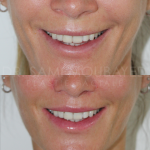 Source: Dr. Moubayed’s practice. Not a guarantee of results. Photos published with informed written consent of patients Female treated with lip lift in Montreal