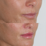 Source: Dr. Moubayed’s practice. Not a guarantee of results. Photos published with informed written consent of patients