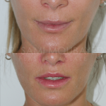 Source: Dr. Moubayed’s practice. Not a guarantee of results. Photos published with informed written consent of patients Female treated with upper lip lift in Montreal