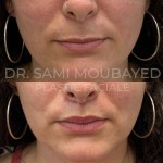 Source: Dr. Moubayed’s practice. Not a guarantee of results. Photos published with informed written consent of patients Female treated with upper lip lift in Montreal