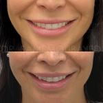 Source: Dr. Moubayed’s practice. Not a guarantee of results. Photos published with informed written consent of patients Female treated with upper lip lift in Montreal