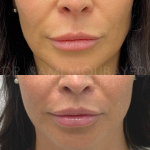 Source: Dr. Moubayed’s practice. Not a guarantee of results. Photos published with informed written consent of patients Female treated with upper lip lift in Montreal