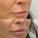 Source: Dr. Moubayed’s practice. Not a guarantee of results. Photos published with informed written consent of patients Female treated with upper lip lift in Montreal