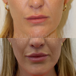 Source: Dr. Moubayed’s practice. Not a guarantee of results. Photos published with informed written consent of patients Female treated with upper lip lift in Montreal