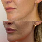 Source: Dr. Moubayed’s practice. Not a guarantee of results. Photos published with informed written consent of patients