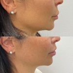 Source: Dr. Moubayed’s practice. Not a guarantee of results. Photos published with informed written consent of patients Female treated with upper lip lift in Montreal