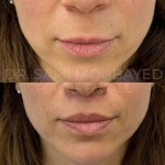 Source: Dr. Moubayed’s practice. Not a guarantee of results. Photos published with informed written consent of patients Female treated with upper lip lift in Montreal