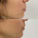 Source: Dr. Moubayed’s practice. Not a guarantee of results. Photos published with informed written consent of patients Female treated with upper lip lift in Montreal