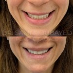 Source: Dr. Moubayed’s practice. Not a guarantee of results. Photos published with informed written consent of patients Female treated with upper lip lift in Montreal