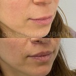 Source: Dr. Moubayed’s practice. Not a guarantee of results. Photos published with informed written consent of patients Female treated with upper lip lift in Montreal