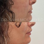 Source: Dr. Moubayed’s practice. Not a guarantee of results. Photos published with informed written consent of patients Female treated with upper lip lift in Montreal