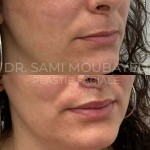 Source: Dr. Moubayed’s practice. Not a guarantee of results. Photos published with informed written consent of patients Female treated with upper lip lift in Montreal